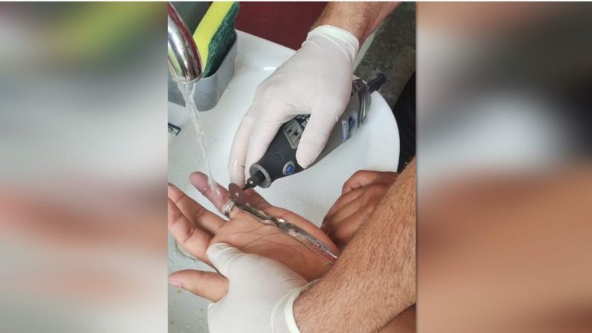 Manaus registra aumento de ocorrências com anéis presos e ultrapassa 500 casos